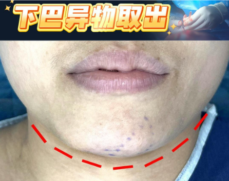 黎星生长因子修复后会反弹吗?不易反弹!上千实例跟踪,复发率低于 5%