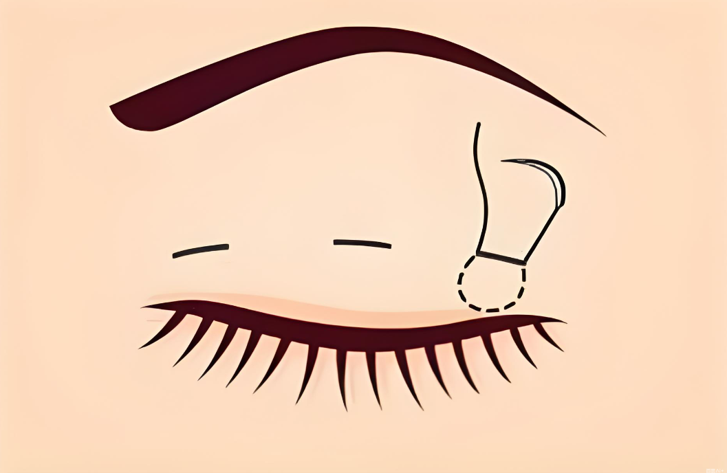 韓國雙眼皮不開刀好不好www.66ub.cn