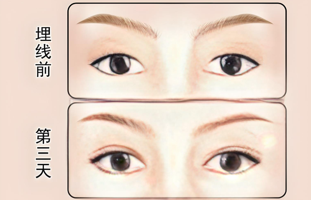 韓國雙眼皮不開刀