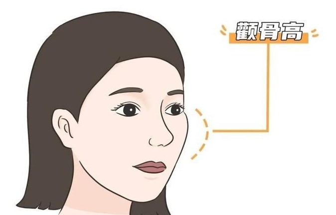 成都友谊李继华颧骨内推价格3.2万起,双端点固定防下垂更自然更安全!