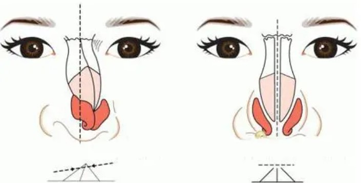 吳輝骨皮質(zhì)隆鼻口碑好