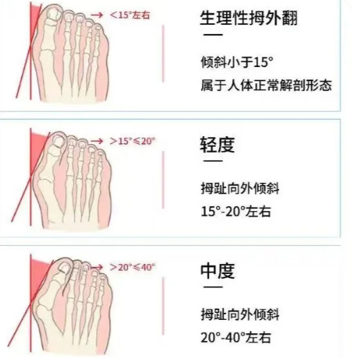 北京圣嘉新治疗拇外翻哪位医生做的好？苏敬达技术获赞，1.28w起微创矫正不踩雷