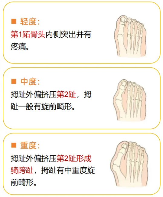 北京圣嘉新大脚骨技术优势