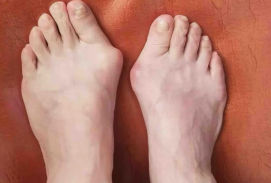 苏敬达微孔矫正术后,变好其实很轻松