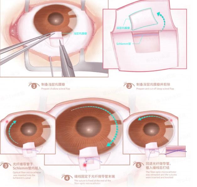 淄博做激光近视手术多少钱？2025年全飞秒1.5万起，半飞秒8800元起