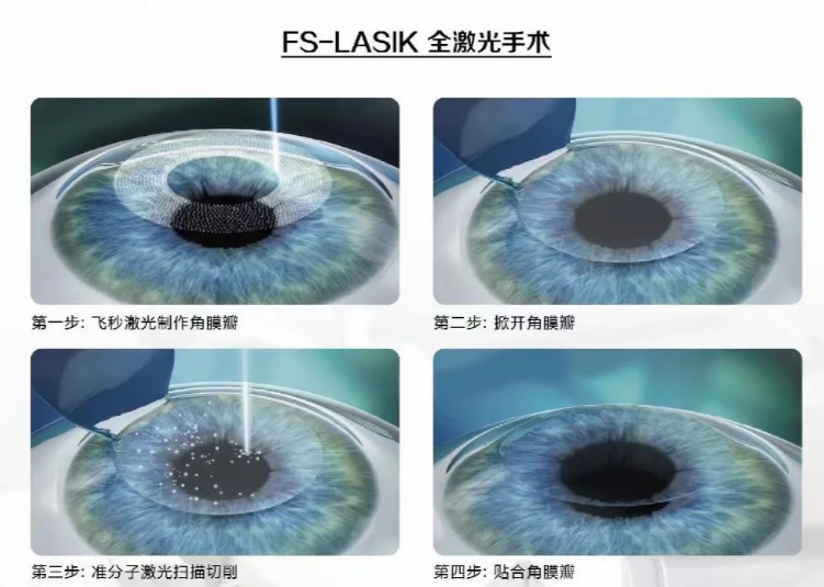 淄博做近视手术,这3点必须提前问清楚,不然容易被“套路”