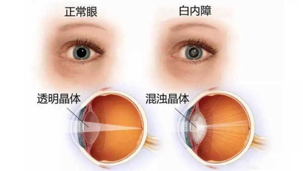 秦皇岛视光眼科医院白内障