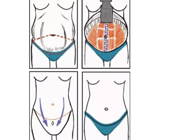 李献和医生擅长领域之腹壁整形