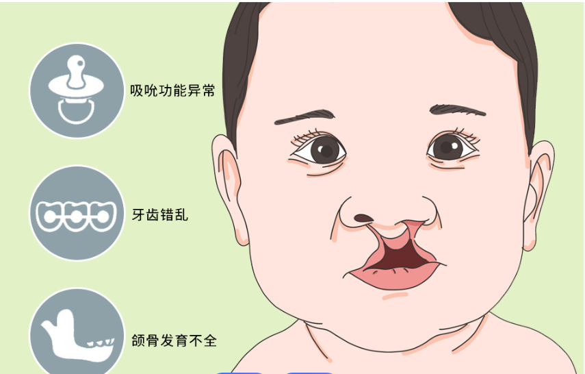 尹宁北唇腭裂手术价格表:兔唇14300起,二期修复14507-70592元起,技术挺靠谱的