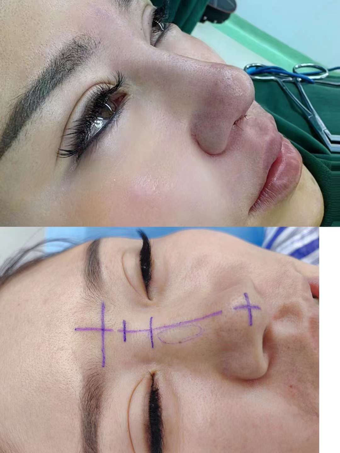 2026韩国隆鼻手术真实感受大揭秘:5家首尔热门医院技术PK,从2万到6.8万韩币的变美账本全公开!