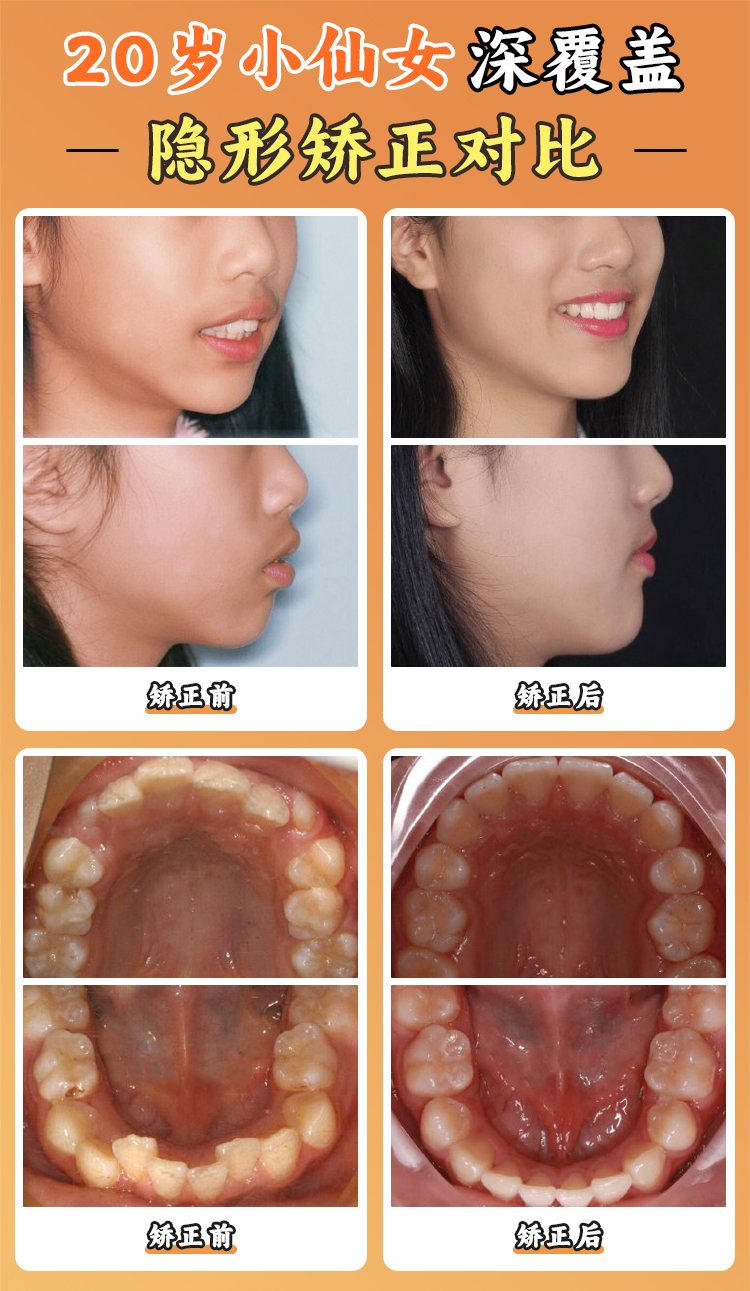 嘉兴圣禾口腔价格表大公开！种植牙低至1980元起牙齿矫正6999元起超划算 