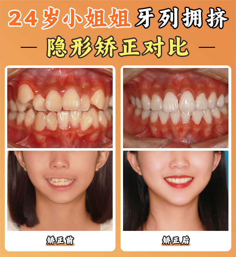 深圳格伦菲尔口腔门诊部可以用医保吗？答案是肯定的，正畸种牙实惠又有保障！ 