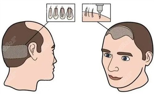 20251029174125.jpg 發(fā)際線植發(fā).jpg