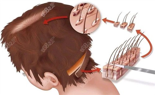 20251029556920.jpg 毛囊移植部位演示圖.jpg