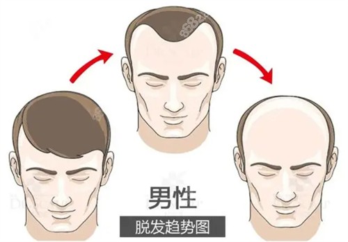 20251029625477.jpg 脫發(fā)趨勢圖.jpg