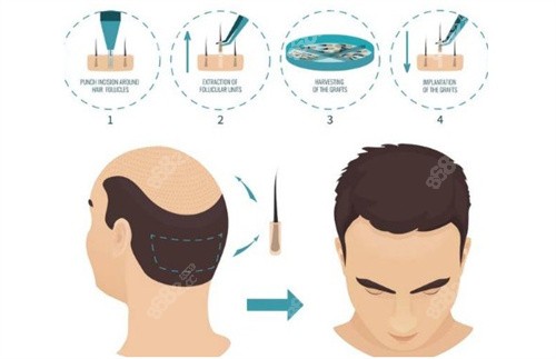 20251029884892.jpg 不同的植發(fā)類型.jpg