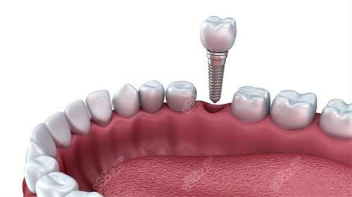 兰州种植牙多少钱一颗？单颗/半口/全口价格+医院推荐