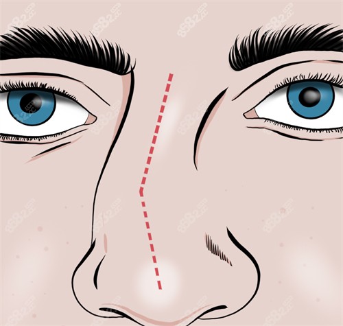 歪鼻对五官不友好