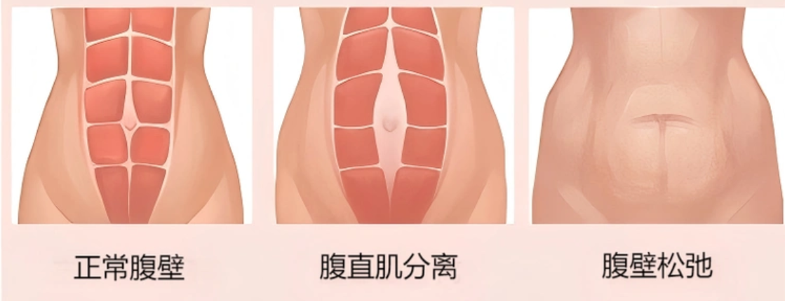 梁紅偉腹壁成形費(fèi)用表揭秘：3.8-15萬左右！迷你 / 標(biāo)準(zhǔn) / 重度術(shù)價(jià)格差多少？避坑指南來了！