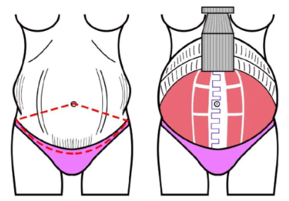 梁紅偉腹壁成形怎么樣