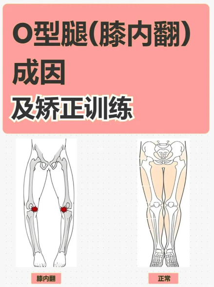 北京知音整形O型腿矯正值不值得做？3萬元起GS復合腿型矯正術(shù)，自然直腿不硬掰骨頭！
