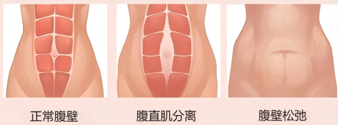 	腹壁整形后肚皮變硬有褶皺？別慌！1-6 個月恢復時間表，正?，F(xiàn)象這樣緩解！