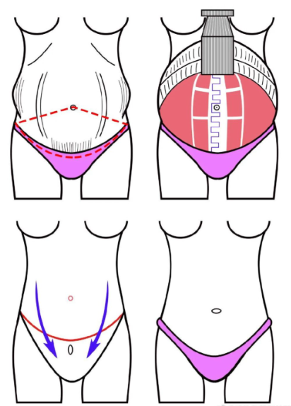 腹壁整形后肚皮變硬好多褶皺怎么辦