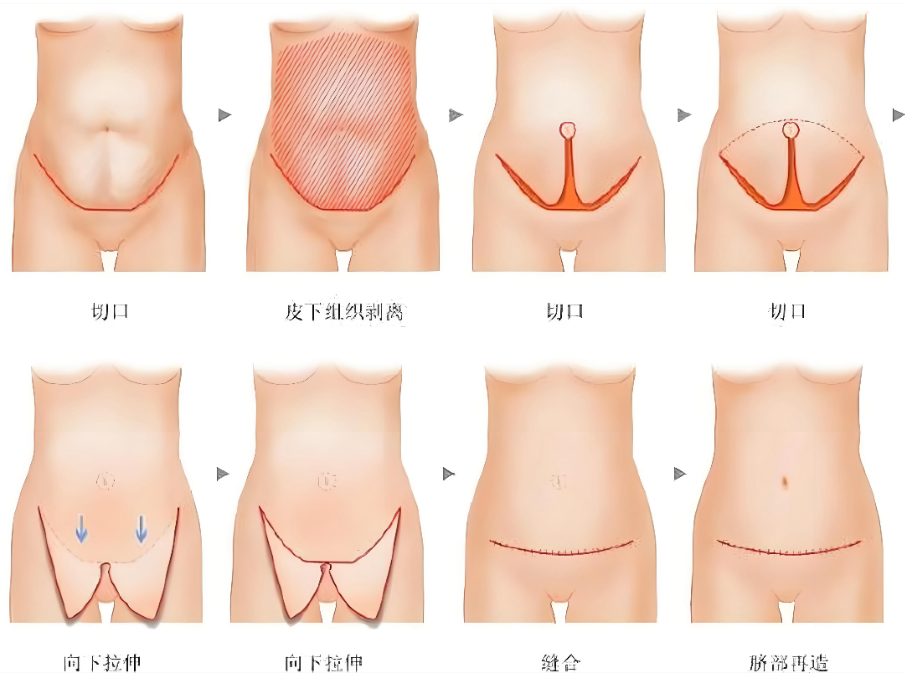 腹壁整形手術(shù)過程示意圖