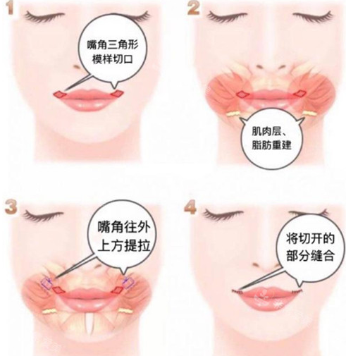 成都趙久麗唇厚改薄手術(shù)價格