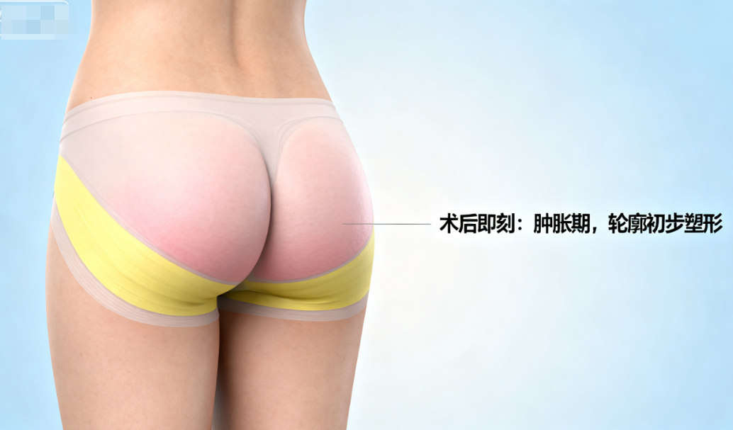 媽媽臀吸脂術(shù)后圖
