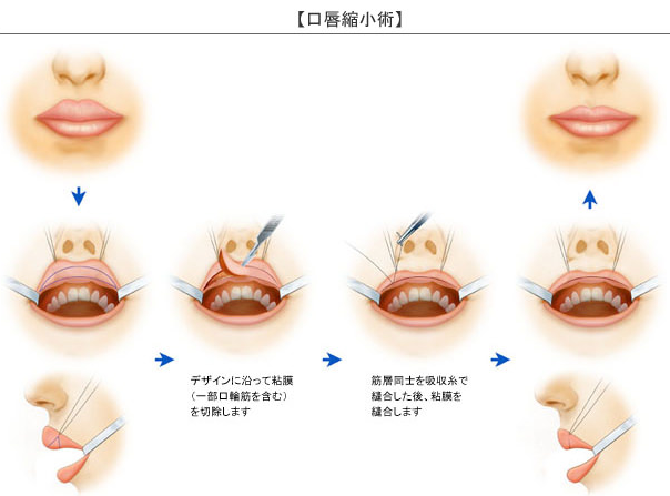 成都趙久麗唇厚改薄手術(shù)過程