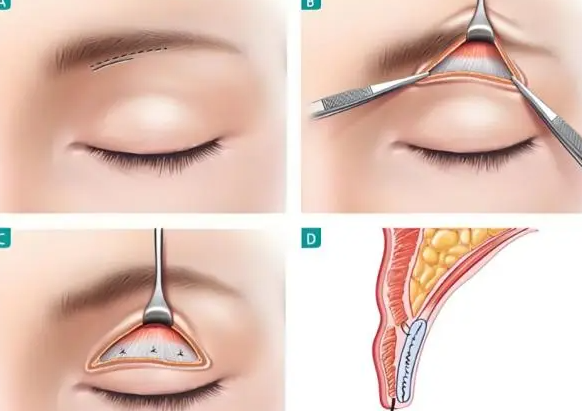湘潭割雙眼皮好的醫(yī)生排名推薦：王瑞平、李為儒、張姣姣等5位
