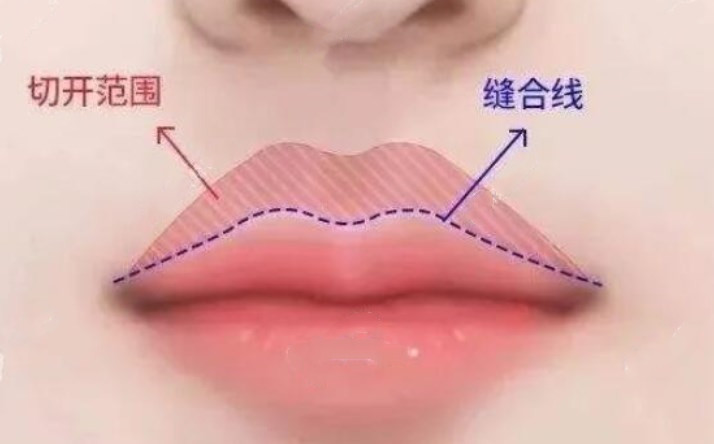 李澤內(nèi)切人中縮短靠譜