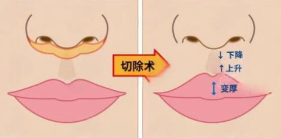 李澤醫(yī)生做內(nèi)切人中縮短的優(yōu)勢