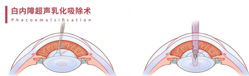 常德白內(nèi)障手術(shù)免費政策新出爐，60歲以上老人福利來了，速看