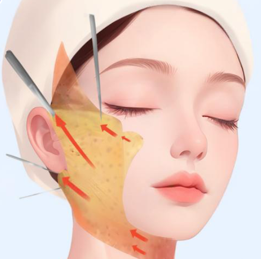 童颜微提和筋膜提升差别