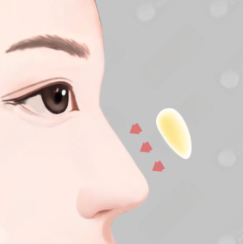 艾丝乐骨性材料填充鼻子疗效好