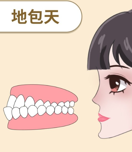 韩国正颌手术改善地包天成效好