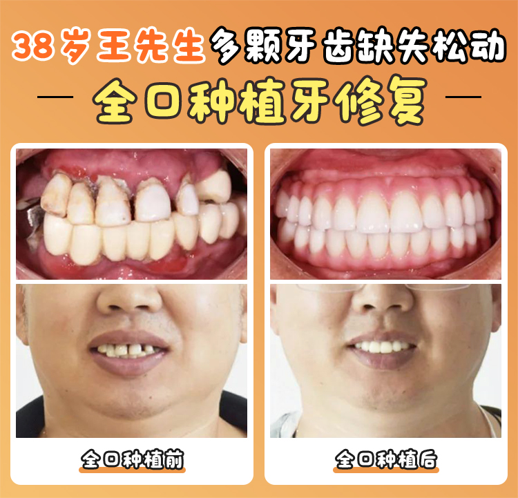 四、重慶齒齒美口腔種植牙性價(jià)比高嗎？