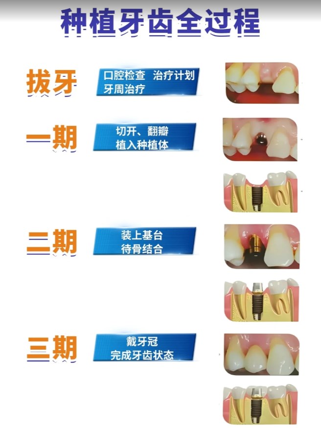 五、重慶齒齒美口腔種植牙質(zhì)保完善嗎？