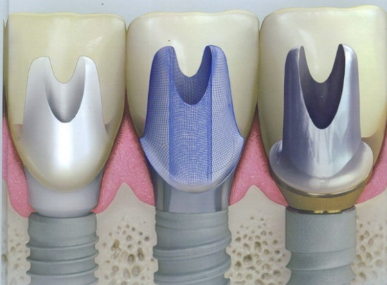 六、重庆齿齿美口腔种植牙成功病例多吗？