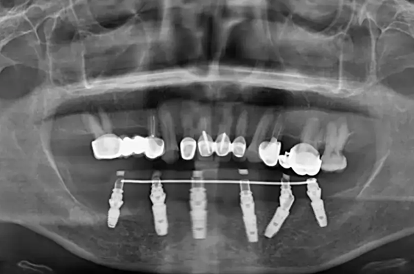 七、重慶齒齒美口腔種植牙口碑評(píng)價(jià)如何？