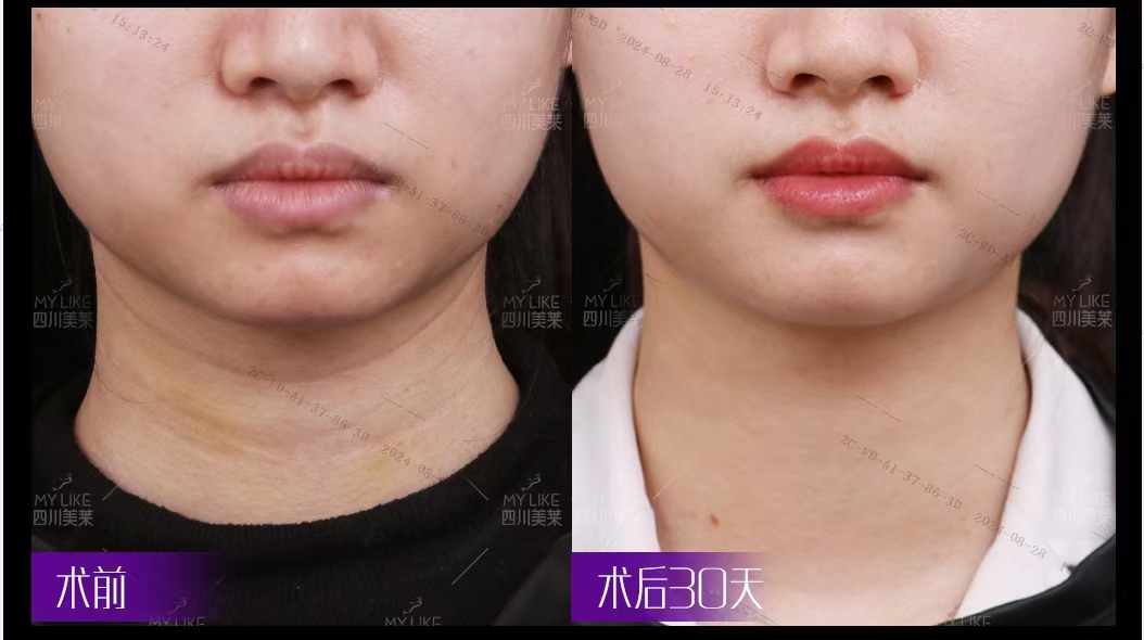 五、成都英博口腔種植牙價格