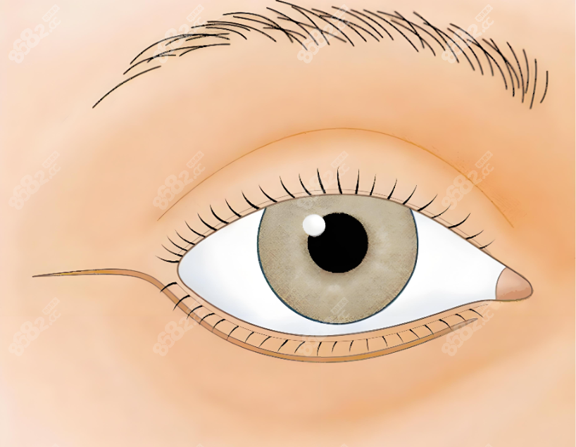 大連劉志剛醫(yī)生修復下眼瞼外翻靠譜