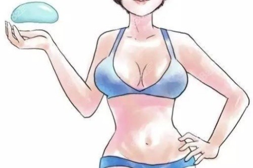 假體豐胸卡通圖 假體豐胸卡通圖