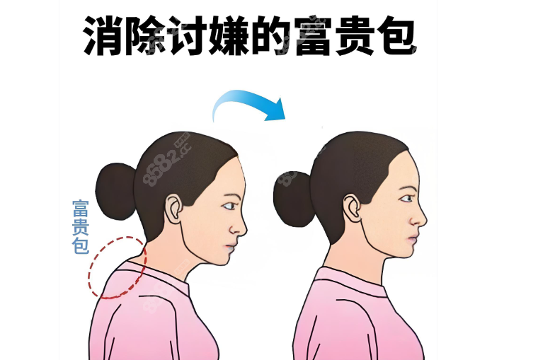 廣州李方偉做富貴包無(wú)后遺癥 廣州李方偉做富貴包無(wú)后遺癥