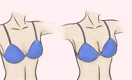 隆胸對比 隆胸對比