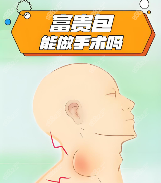 廣州李方偉做富貴包無(wú)后遺癥www.66ub.cn 廣州李方偉做富貴包無(wú)后遺癥www.66ub.cn