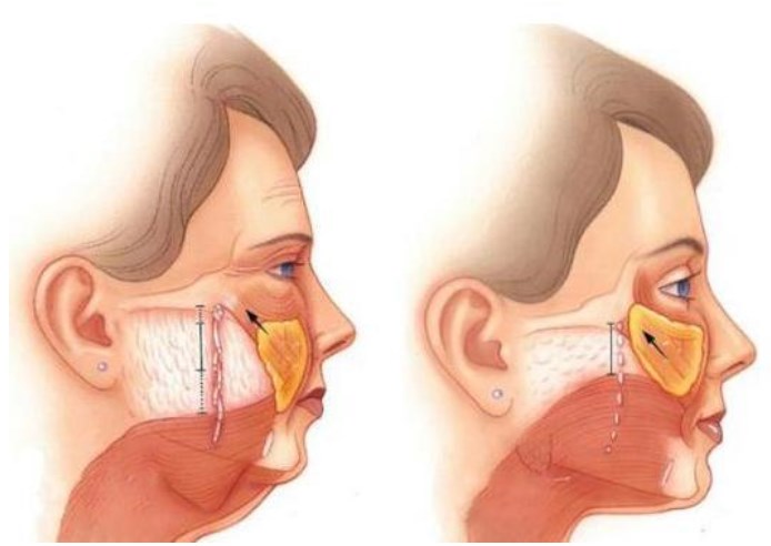 吴芝沅医生在韩国口碑与评价:双w复位提升价格38000元起,技术细腻口碑好!
