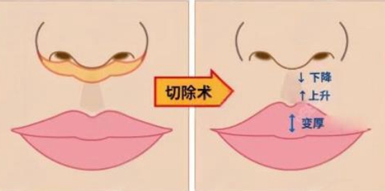 赵久丽人中缩短术疗效展示